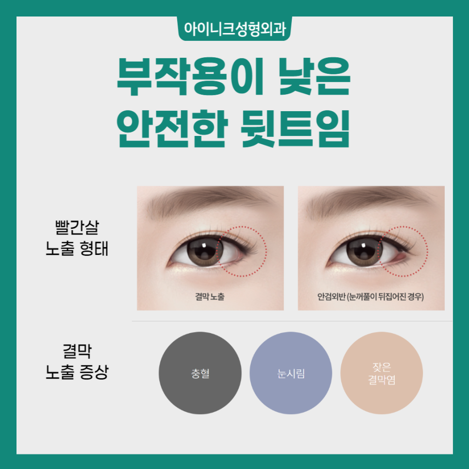 Various Canthoplasty Procedures: Which Design Suits Me Best? image 6