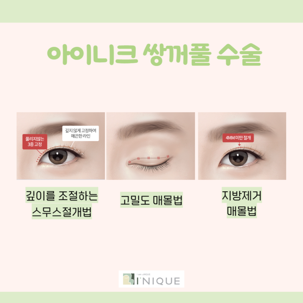 쌍꺼풀만들기 고민하고 계신가요? 관련 이미지 2