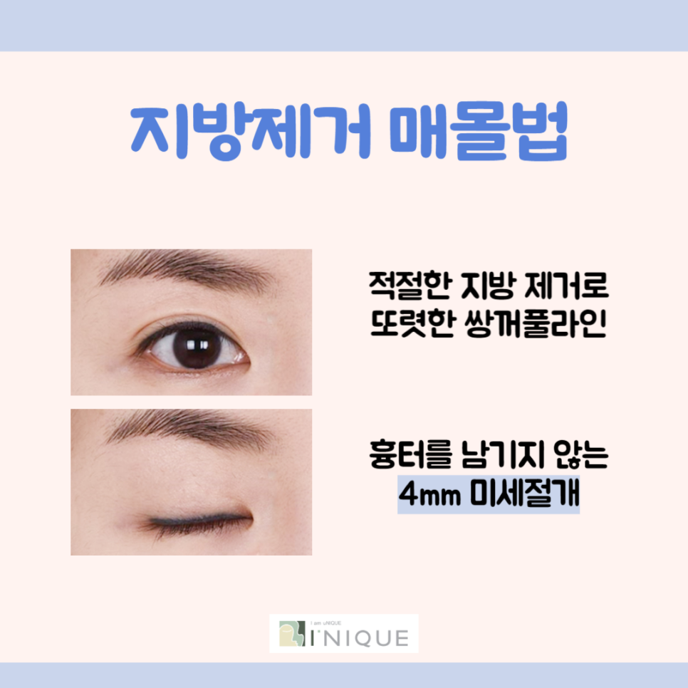 눈쌍꺼풀수술 나에게 맞는 수술은? 관련 이미지 4