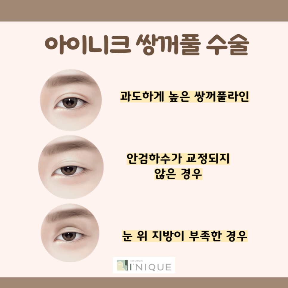 쌍꺼풀재수술잘하는병원은 바로 여기 관련 이미지 2