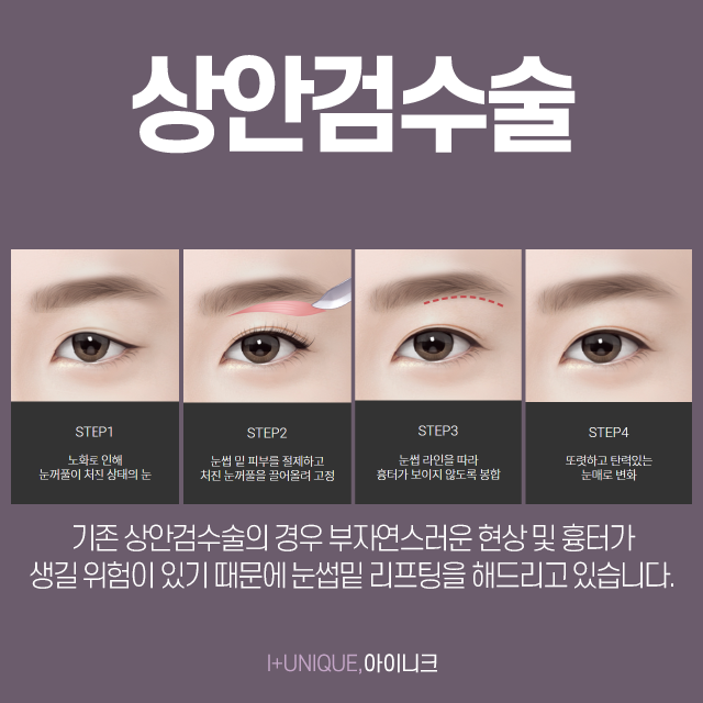 압구정 상안검수술 눈꺼풀이 늘어진 분이라면 주목 관련 이미지 4