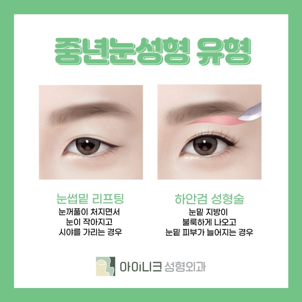 중년눈성형외과 처진 눈 개선하기 관련 이미지 4