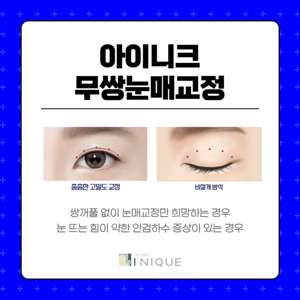 남자무쌍안검하수 자연스러운 교정을 원한다면 관련 이미지 3