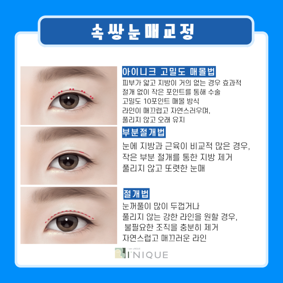 남자쌍꺼풀수술비용 보다 중요한 것은? 관련 이미지 4