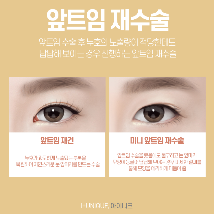 다시 내 눈을 크고 시원하게, 트임재수술도 아이니크성형외과 관련 이미지 2