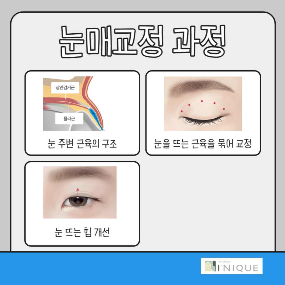 처진눈성형, 또렷한 눈매를 위한 가장 확실한 방법 관련 이미지 4