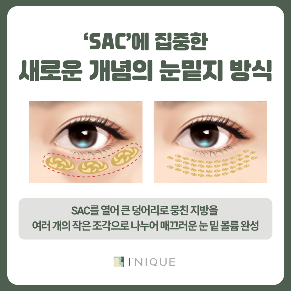 압구정로데오 눈밑지방재배치 통증 얼마나 심할까? 관련 이미지 6