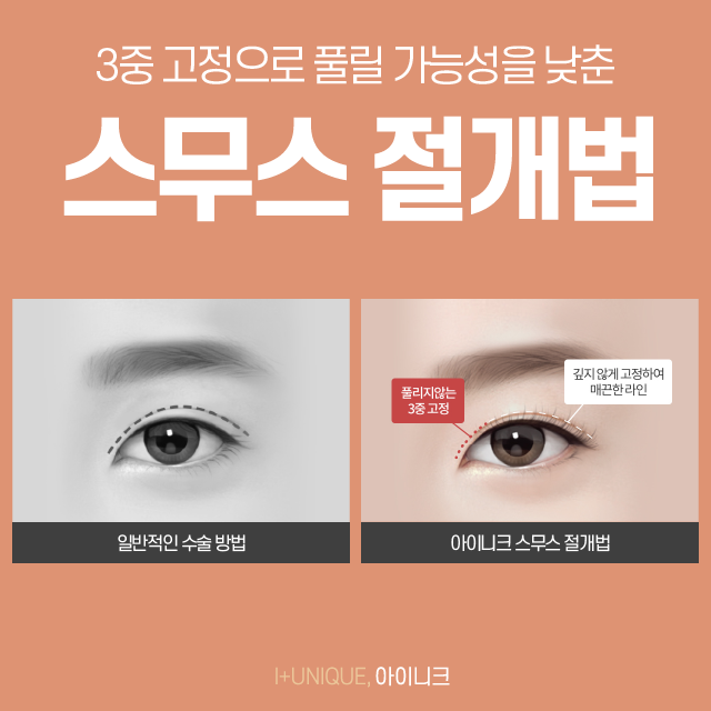 눈두덩이가 두꺼워 고민이라면 지방제거 매몰법! 관련 이미지 2