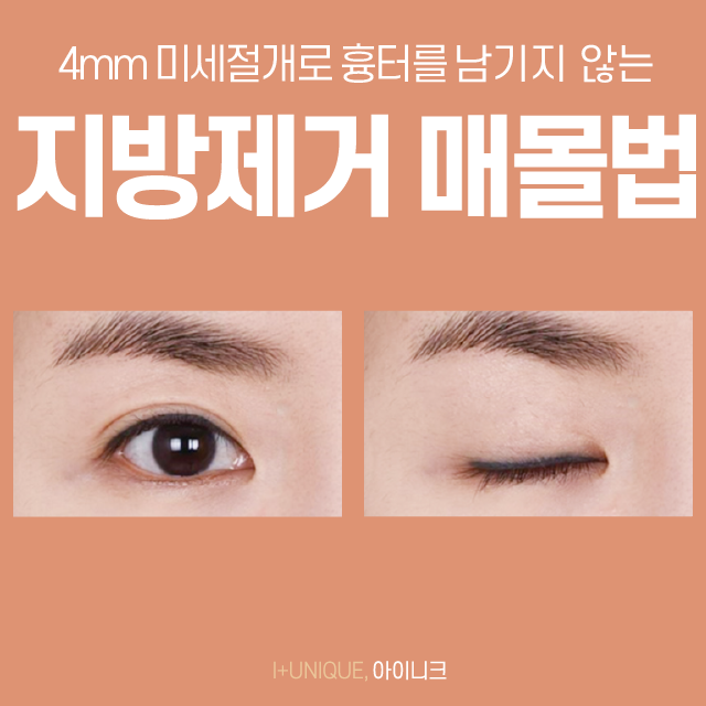 눈두덩이가 두꺼워 고민이라면 지방제거 매몰법! 관련 이미지 4