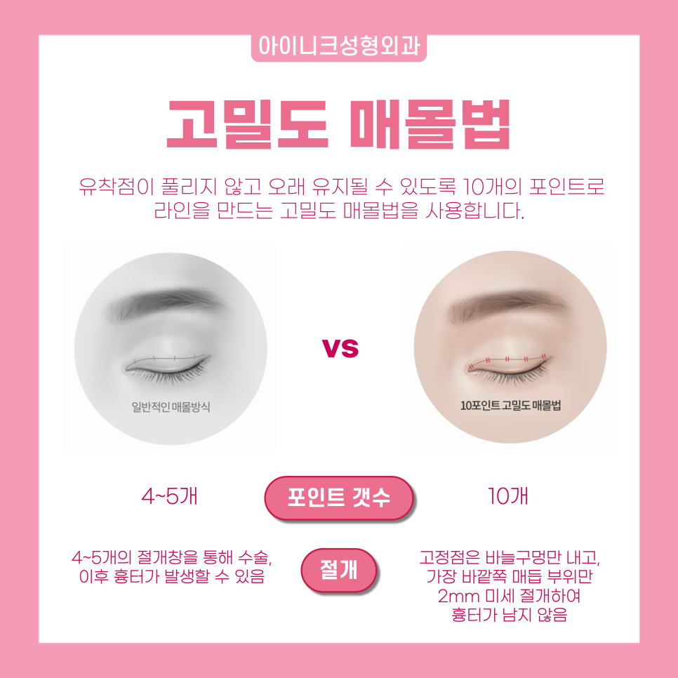 연예인눈성형을 원한다면 눈 성형 전문의에게! 관련 이미지 5
