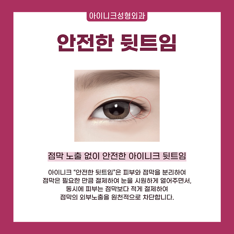 압구정 트임 수술 1위! 자연스럽고 확실한 인상 변화 관련 이미지 6