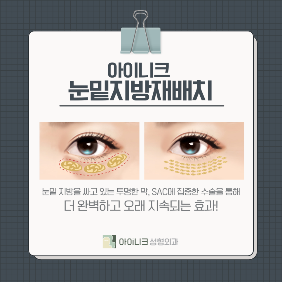 동안을 꿈꾼다면 앙코르눈밑지방재배치 관련 이미지 4