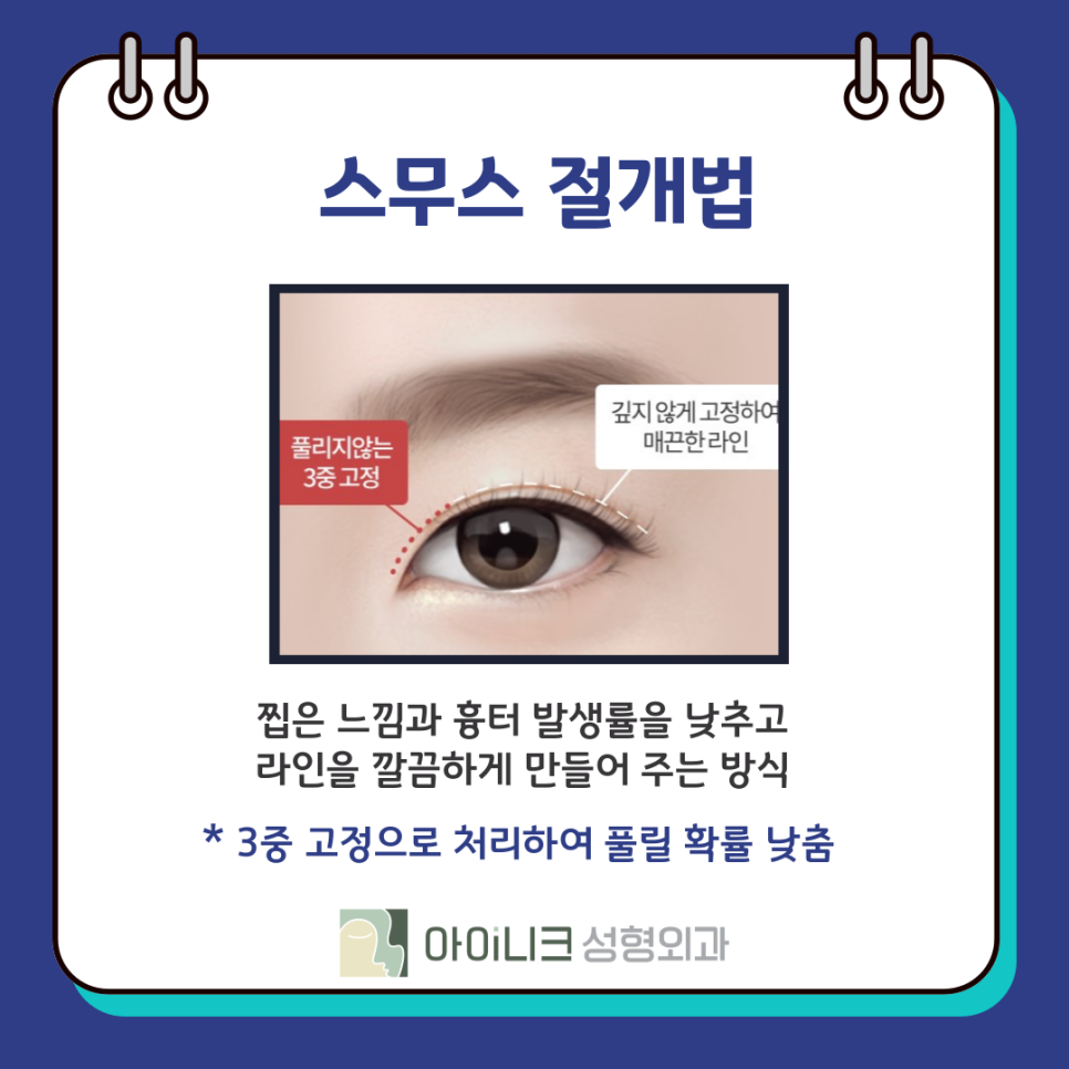 압구정눈성형외과 쌍꺼풀 수술 종류 방법? 관련 이미지 11