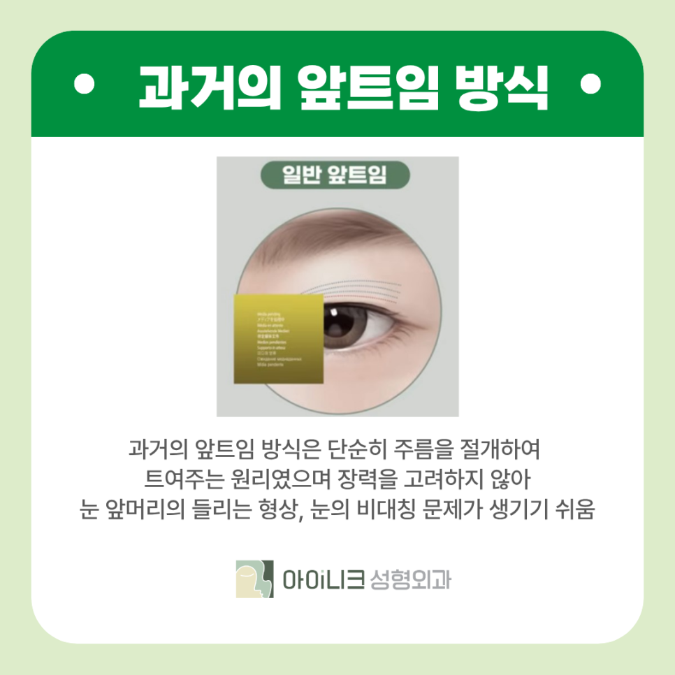 The 20s’ Pick These Days! An Epicanthoplasty Method Without Worrying About Scars image 3