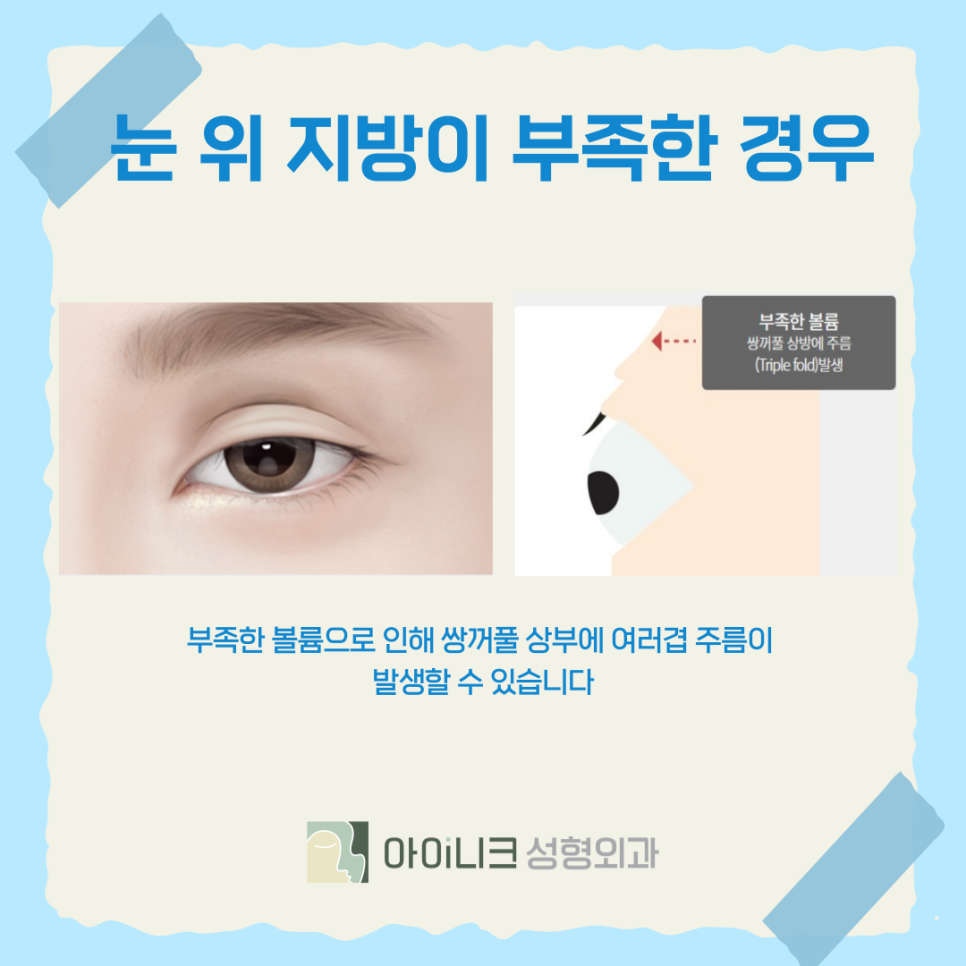 Best Clinic for Double Eyelid Revision Surgery: When Multiple Creases Form image 9