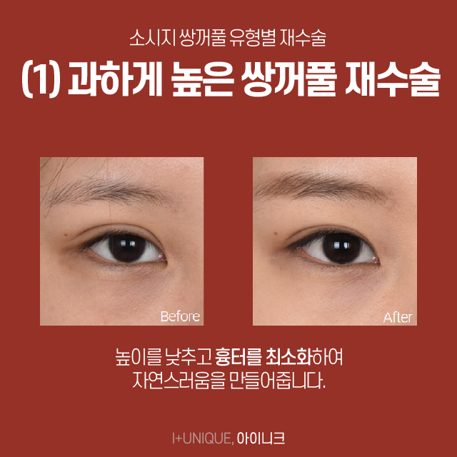 What Should You Do About Uncomfortable Sausage-Like Double Eyelids? image 3