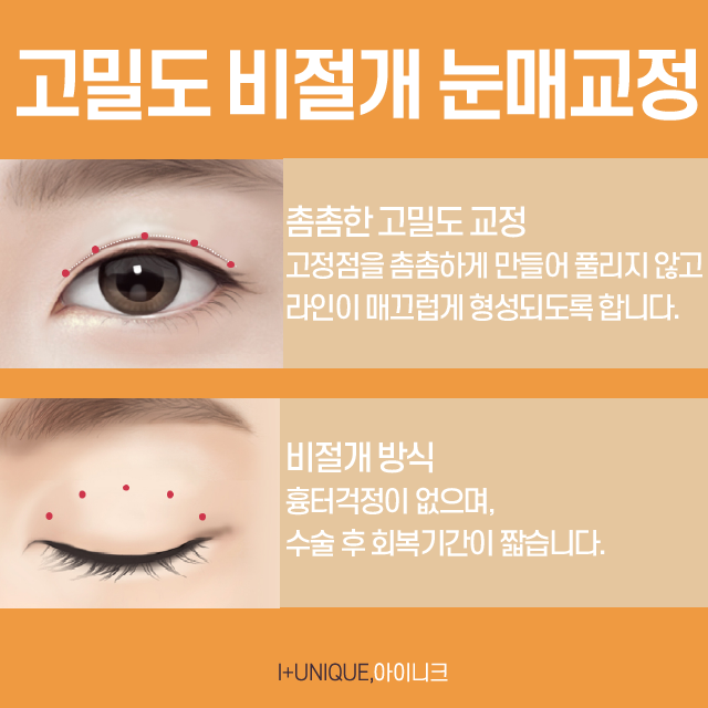 비절개눈매교정, 성공하는 중요한 포인트! 관련 이미지 4