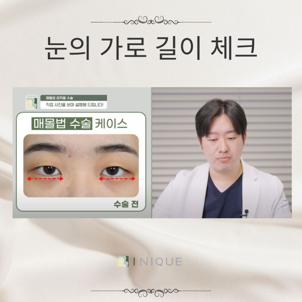 여자눈매몰법 고려해야하는 점 관련 이미지 3