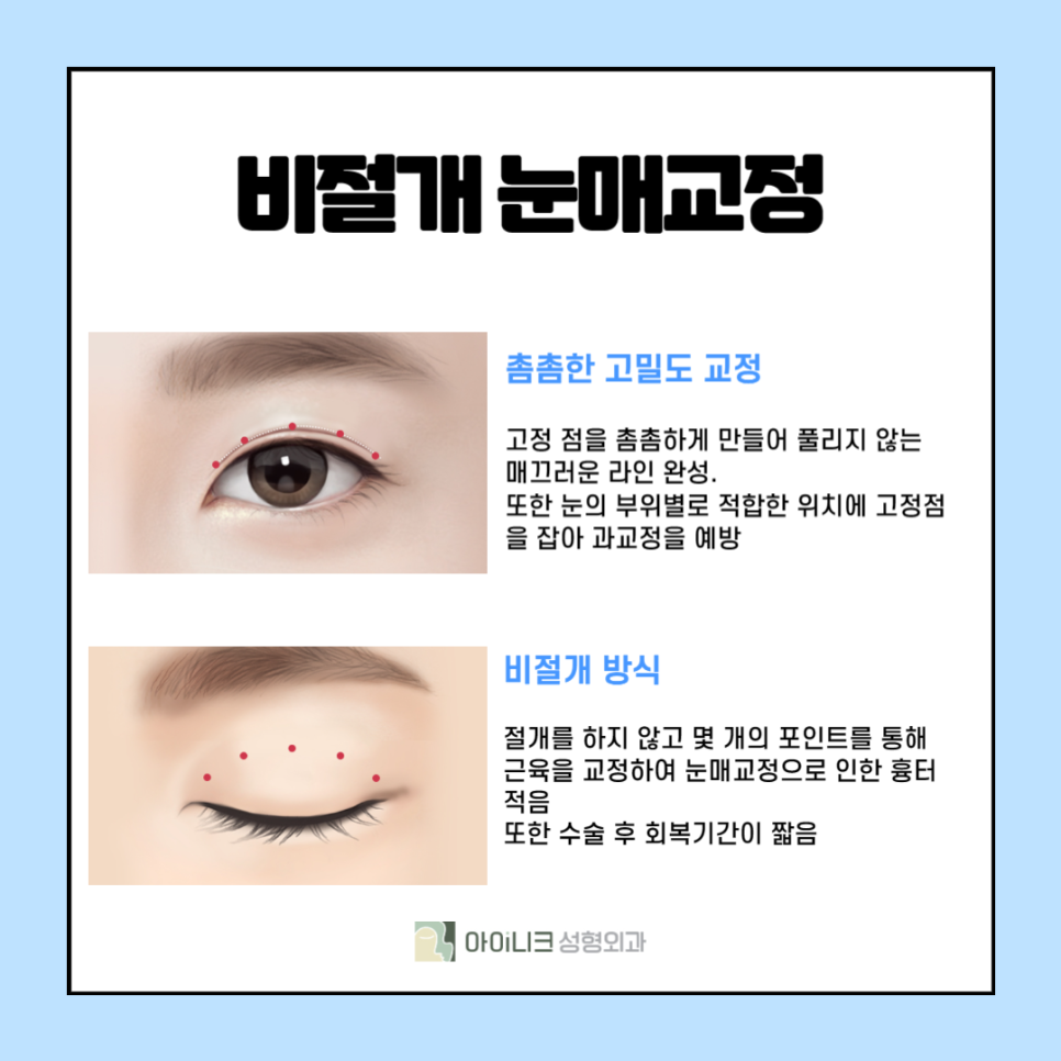 If You're Curious About Eye Correction Surgery Methods? image 4
