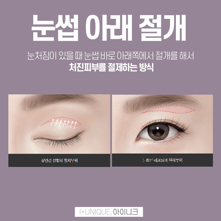 상안검수술 권하지 않는 이유 아이니크성형외과에서 알아보자 관련 이미지 5