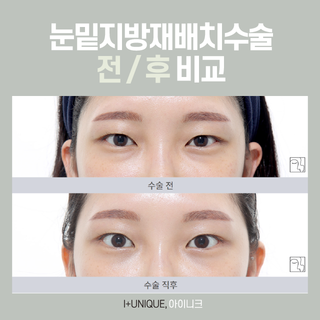 눈밑지방재배치수술 방법, 다른 병원에는 없는 바로 이것! 관련 이미지 5