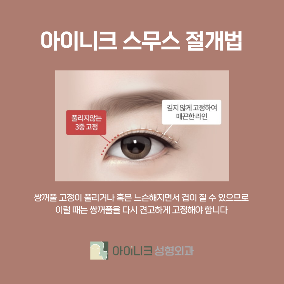 쌍수절개재수술 3중 고정으로 견고하게 관련 이미지 9