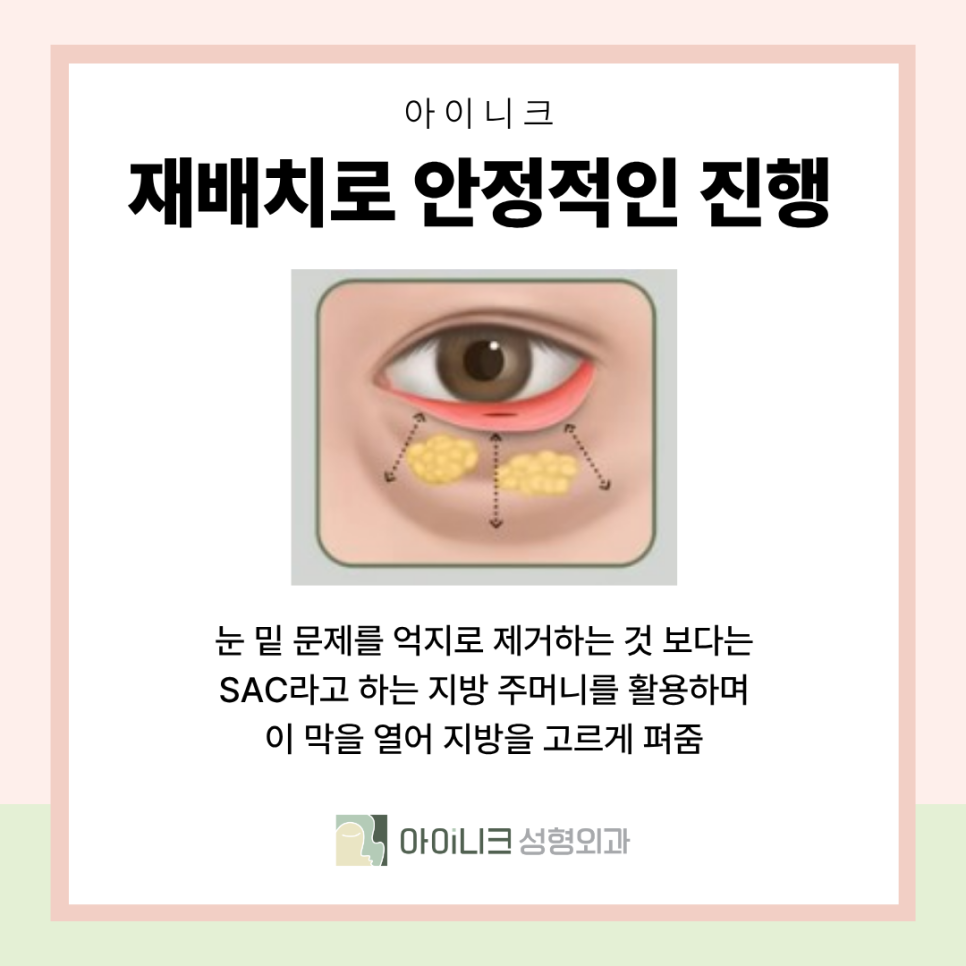 앙코르 눈밑지 비교 일반 방식과의 차이 수술 방법 관련 이미지 6