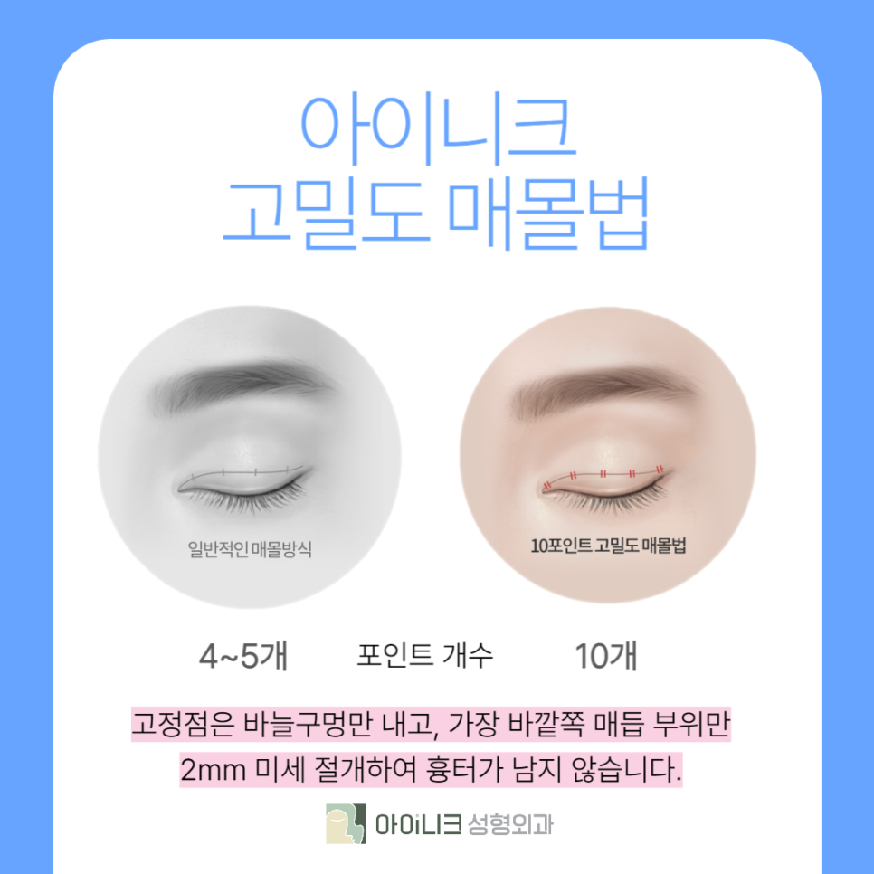 쌍커풀수술잘하는곳 나만의 눈매로 성공했어요 관련 이미지 3