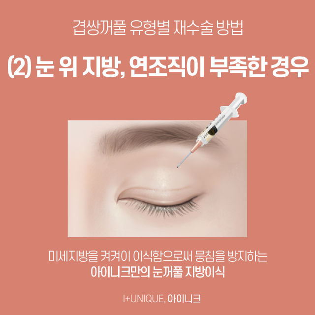 Double Eyelids with Multiple Folds, Also Called “Three-Fold Eyelids”! If You’re Worried About It, Here’s How to Improve It image 4