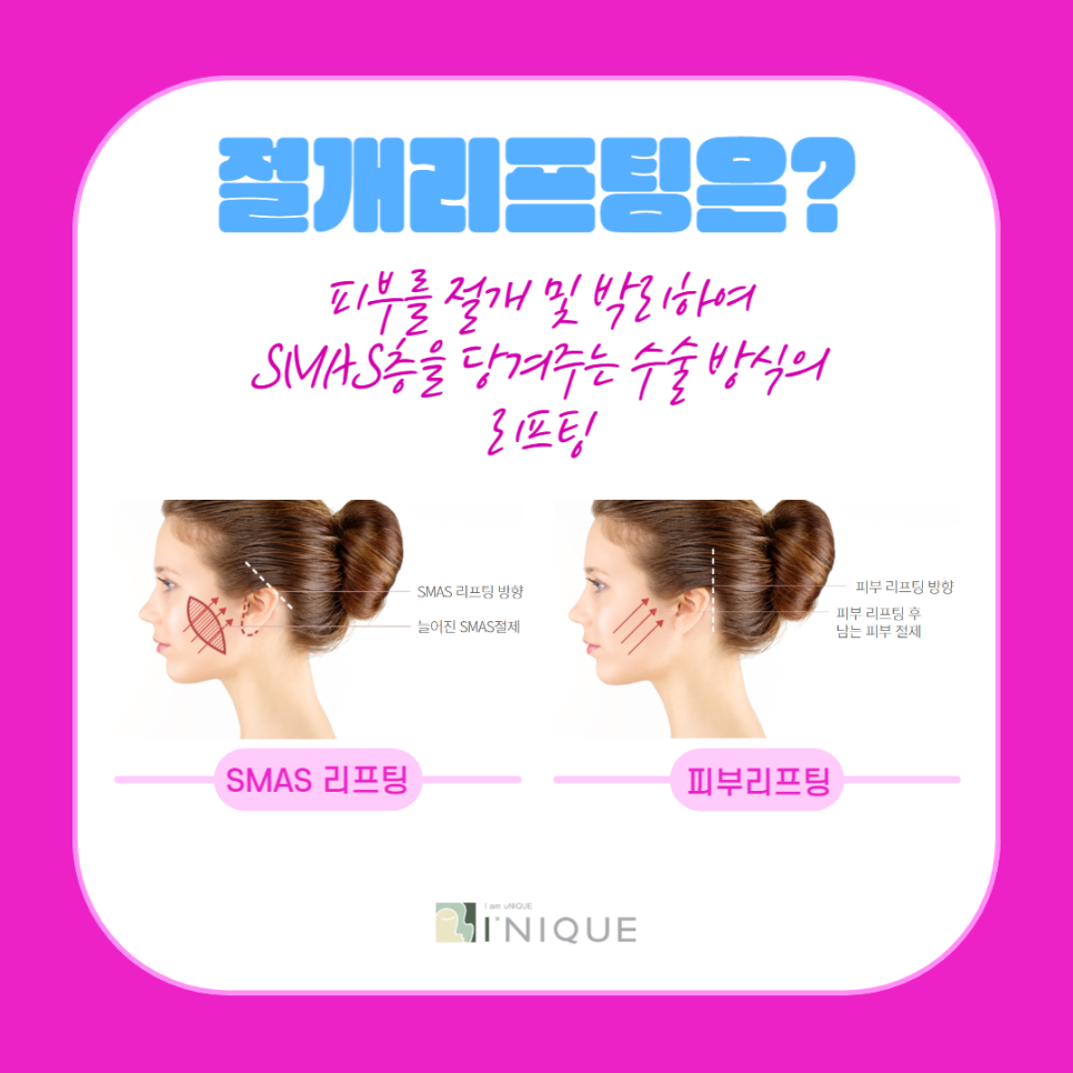 중년동안성형, 자연스럽게 젊음을 되찾는 방법 관련 이미지 3