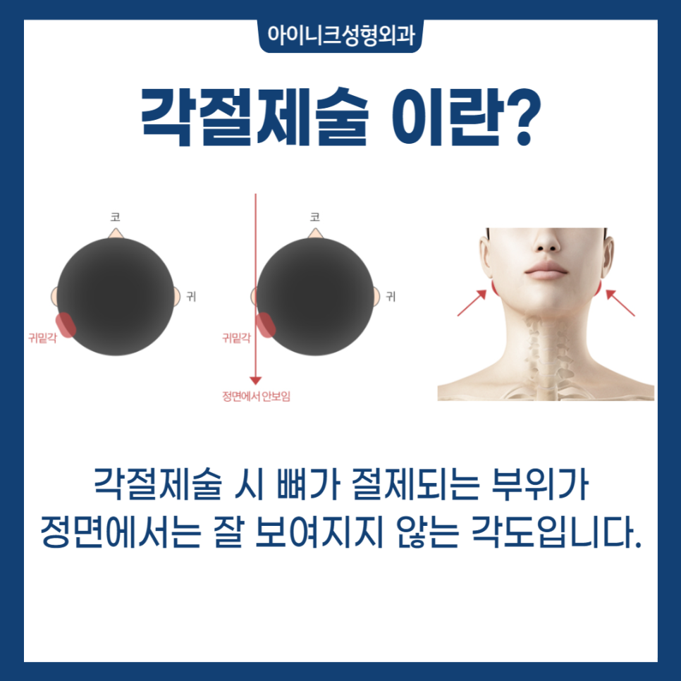 자연스러운 V라인 사각턱성형 관련 이미지 3