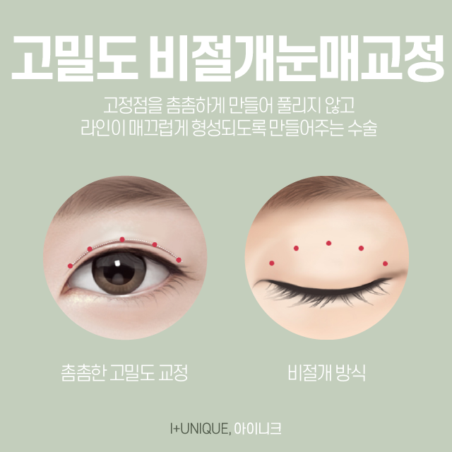 내 눈을 보다 또렷하게 ! 안검하수병원추천 관련 이미지 4