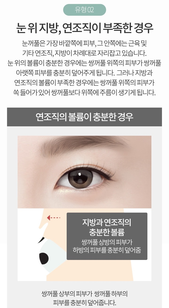 눈꺼풀지방이식비용 자연스러운 눈매로 변신 관련 이미지 4