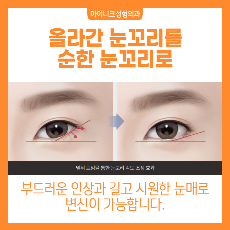 눈트임수술, 내 눈에 딱 맞게 선택하세요 관련 이미지 6