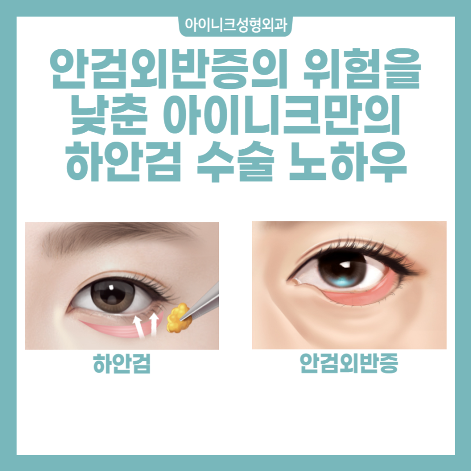 중년눈수술, 젊은 눈으로 되돌리고 싶다면? 관련 이미지 4