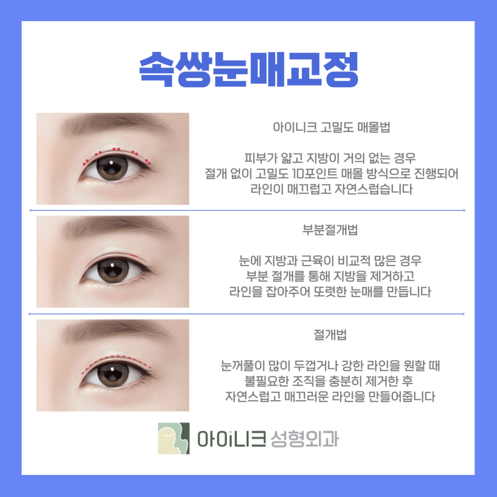 강남 남자 자연스러운 쌍수 또렷하고 티나지 않게 관련 이미지 6