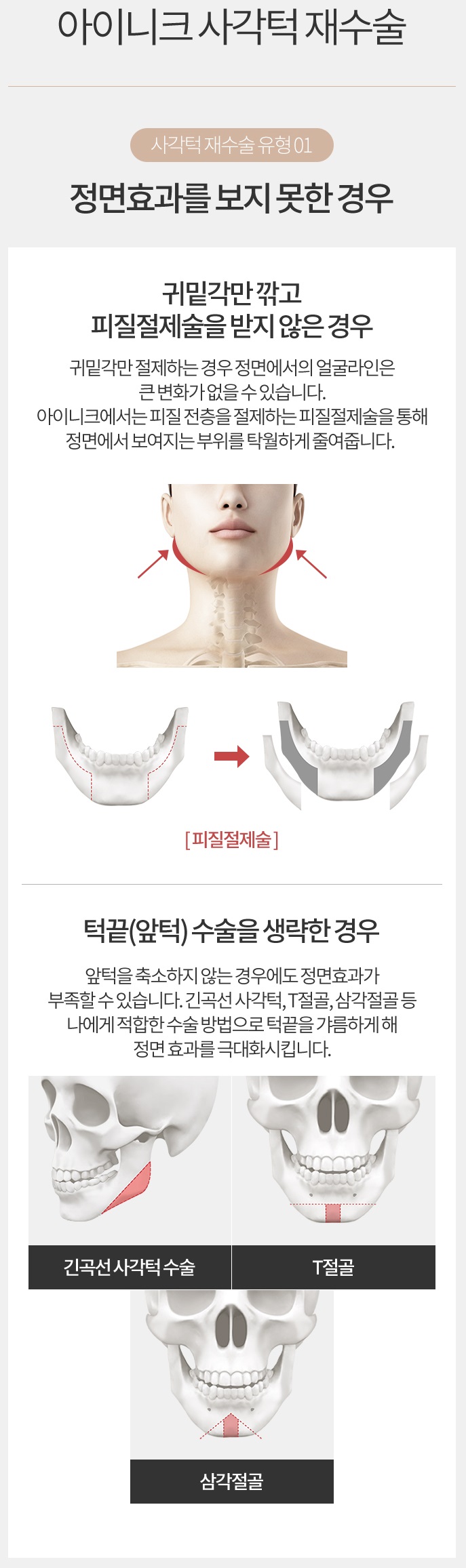 남자안면윤곽수술비용도 아이니크에서 알아보자! 관련 이미지 3