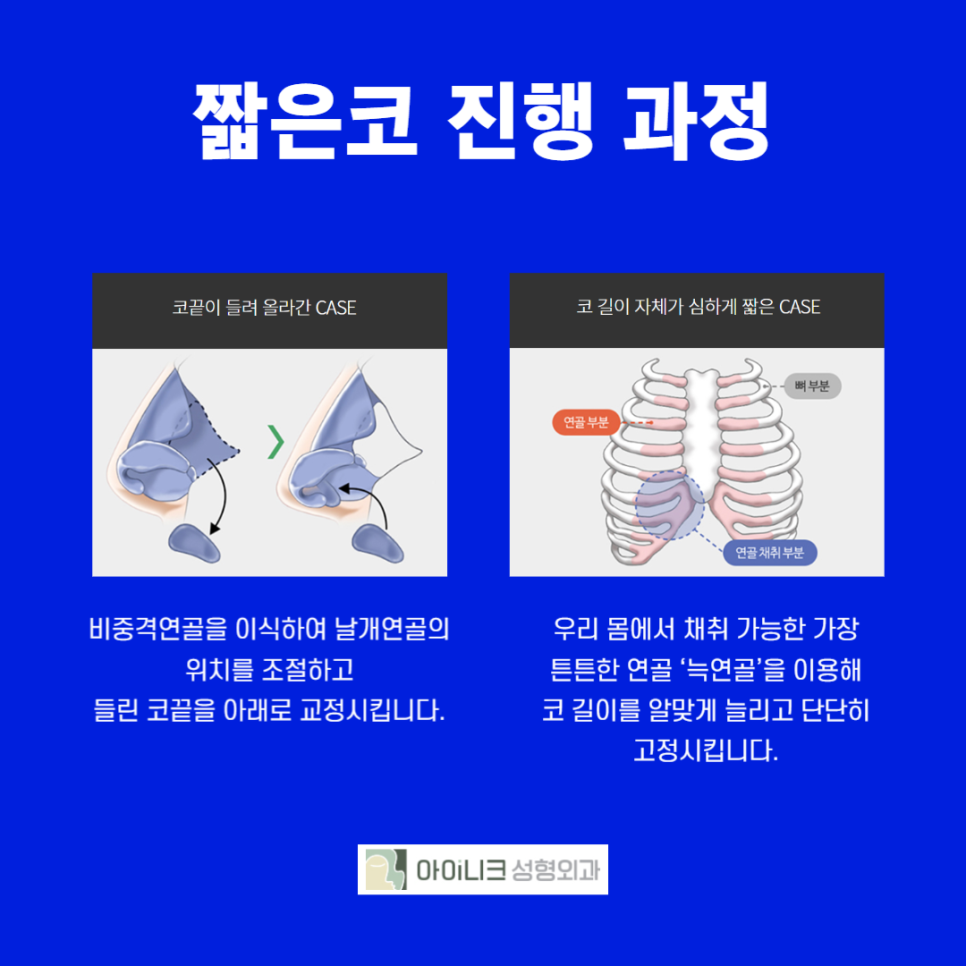 Natural Rhinoplasty with a Personalized Diagnosis image 4