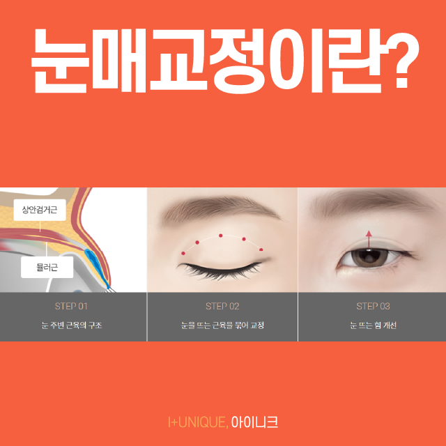 비절개눈매교정술로 자연스럽고 예쁜 눈매 만들기? 관련 이미지 2