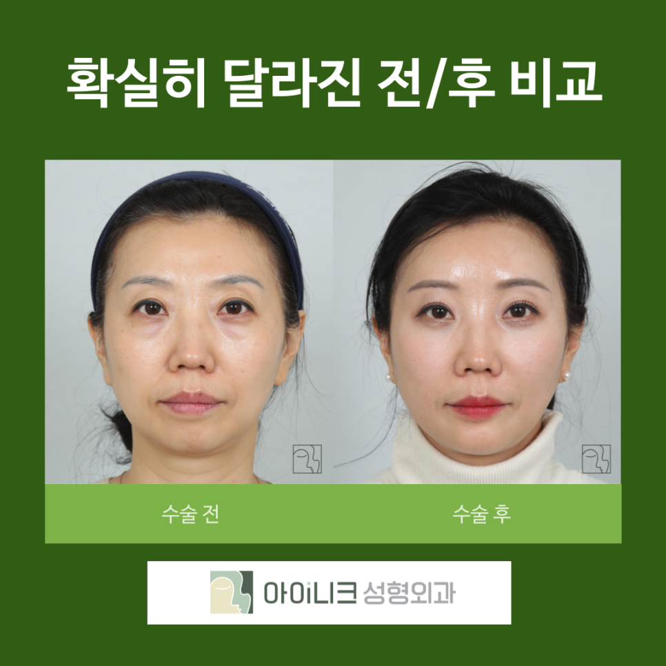 압구정역 눈밑 지방 재배치 후기 성공하는 방법 관련 이미지 5