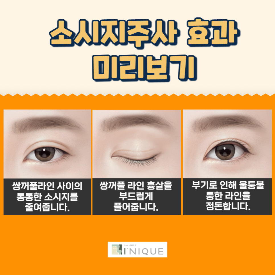 눈붓기주사로 쌍수 후 소시지 고민 해결하기 관련 이미지 5