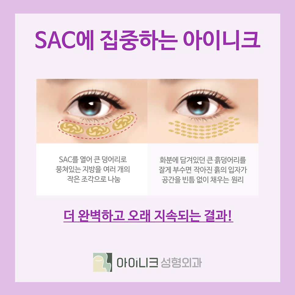 눈밑지방재배치통증 멍 붓기가 적은 아이니크의 노하우 관련 이미지 4