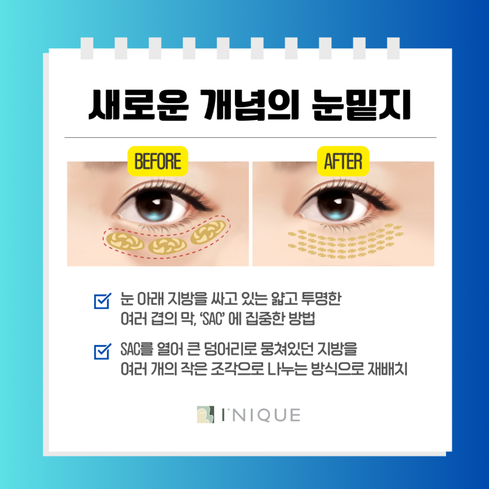 Men Can Get Lower Eyelid Fat Repositioning Too! Seoul Lower Eyelid Fat Repositioning Procedure image 5