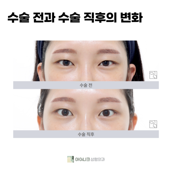 눈밑지방재배치잘하는곳에서 알려주는 꿀팁 관련 이미지 6