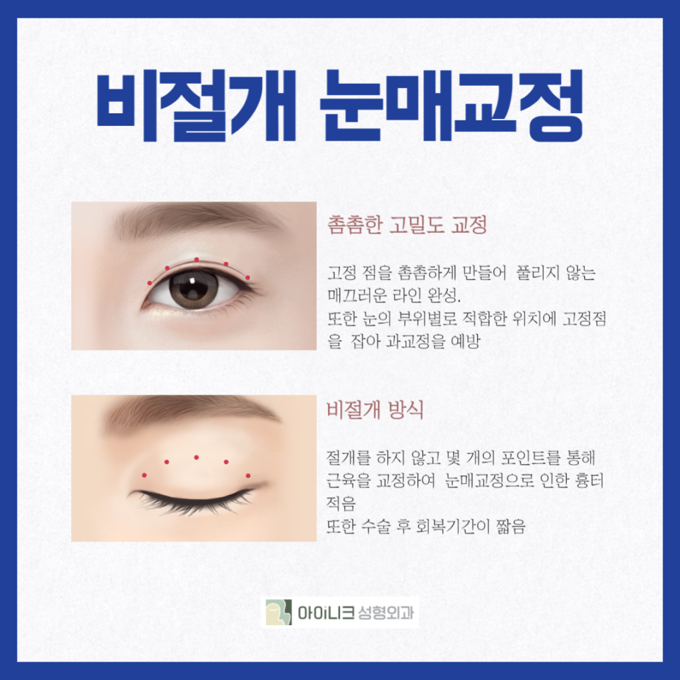 안검하수잘하는곳 찾고 있나요? 관련 이미지 4