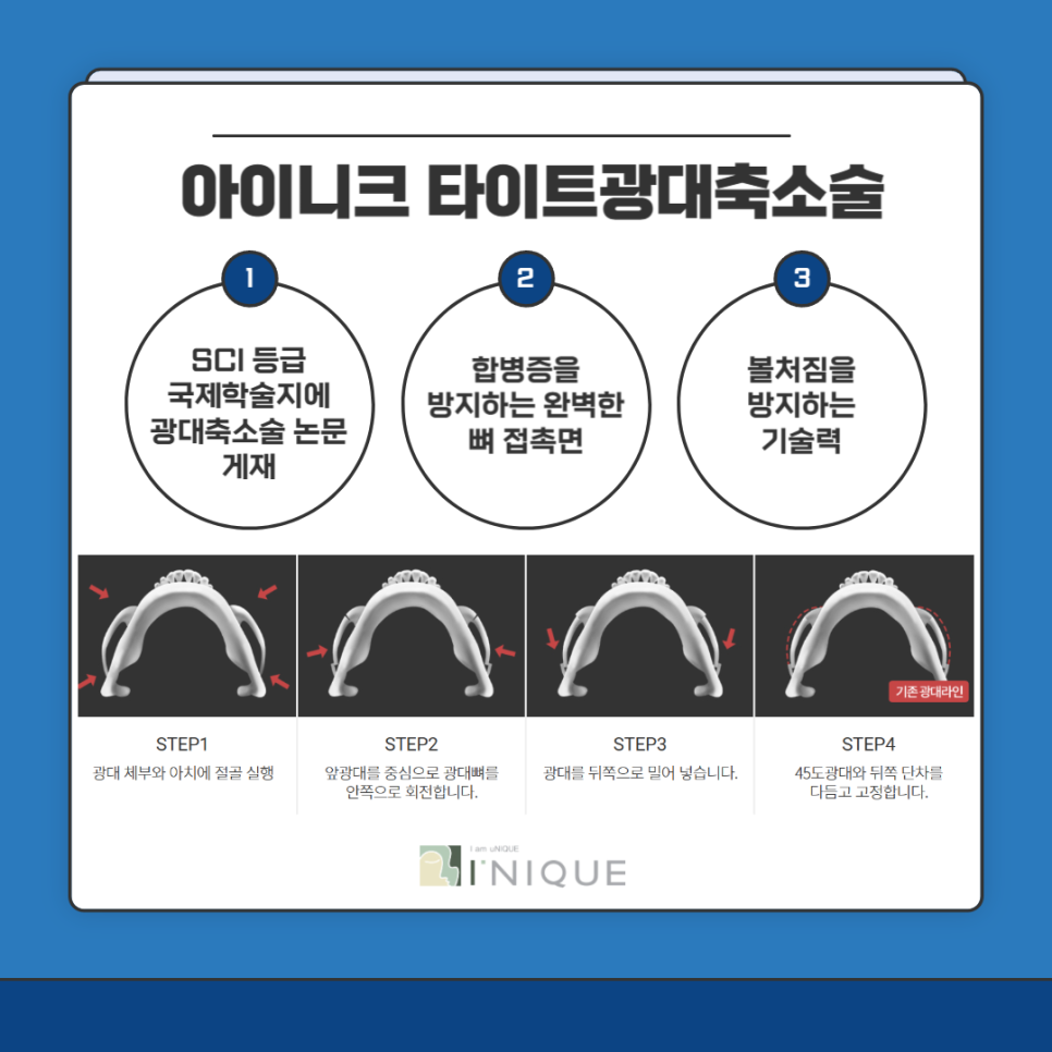 남자안면윤곽수술잘하는곳 포인트! 관련 이미지 5