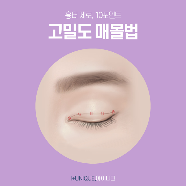 성형의 기본 쌍꺼풀 수술부터 풀린쌍꺼풀, 삼꺼풀 해결 방법까지 모두 알아보기 관련 이미지 3