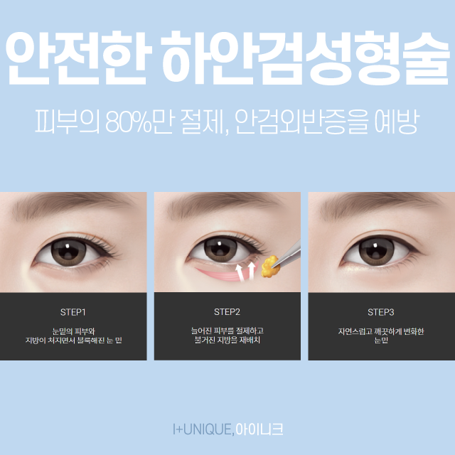 중년 눈 성형, 상안검성형술을 추천하지 않는 이유는? 관련 이미지 4