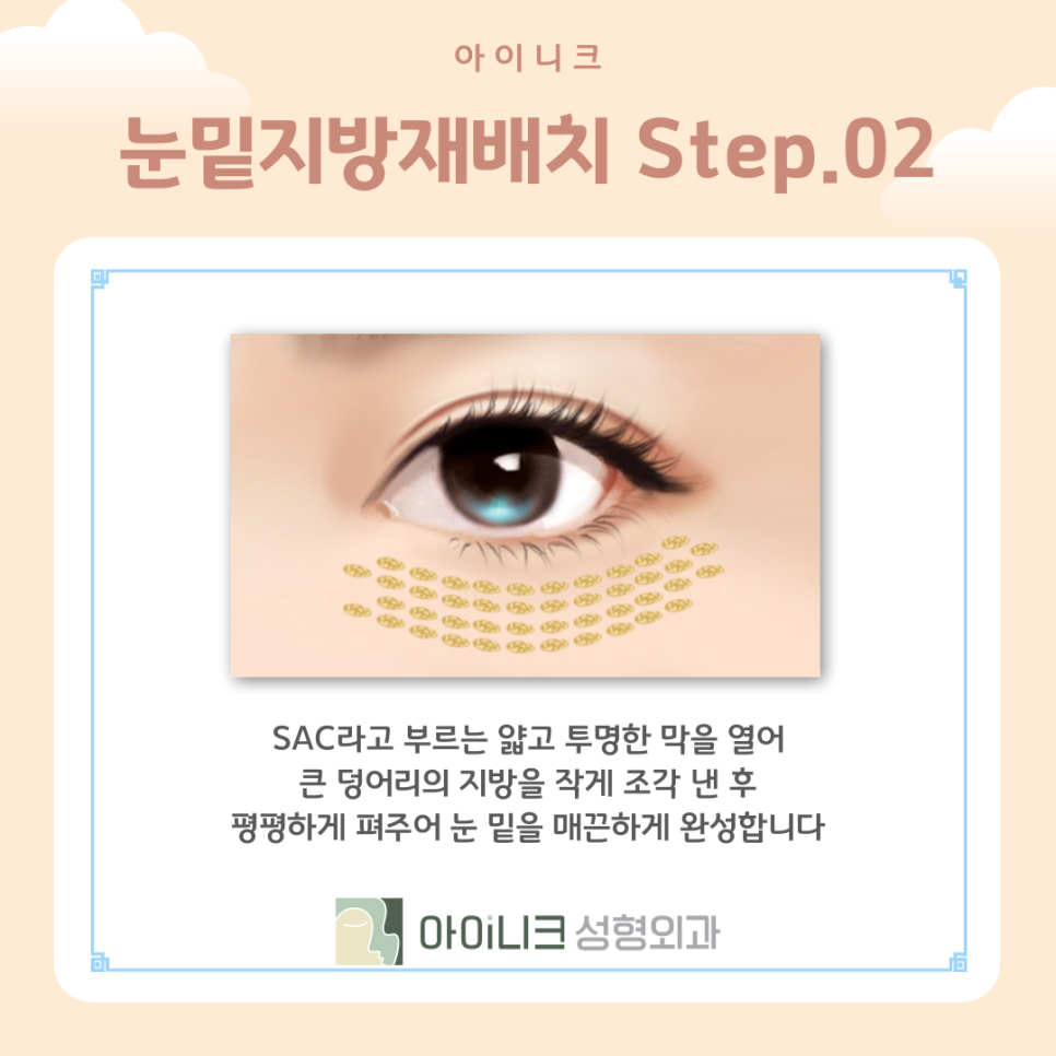 눈밑지방재배치가격만 중요할까? 관련 이미지 9