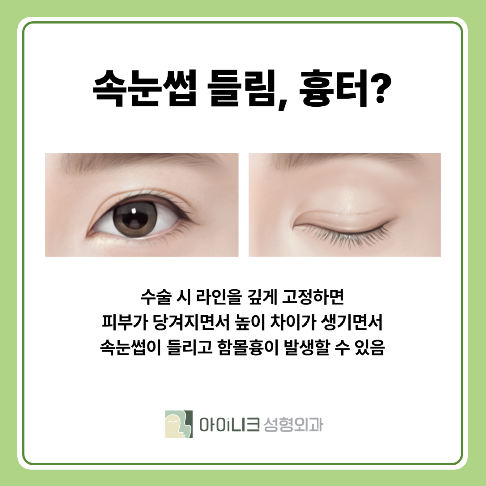 강남 쌍수재수술 필요한 경우와 꼼꼼함의 중요성 관련 이미지 11